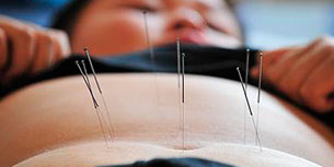 Agujas de acupuntura en el estómago