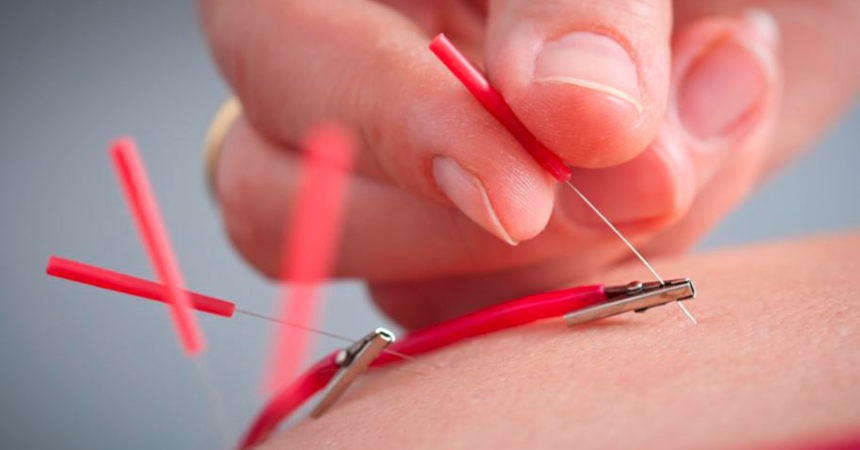 electroacupuntura: acupuntura con electricidad