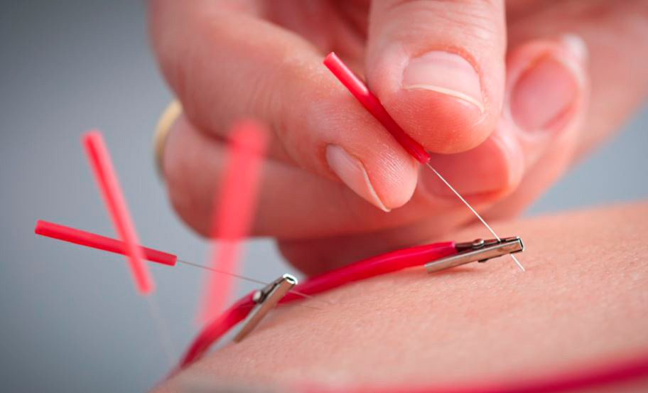 electroacupuntura: acupuntura con electricidad
