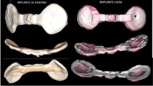 Implantes de las momias de Nazca